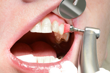歯周病 のステージ毎の症状や治療方法