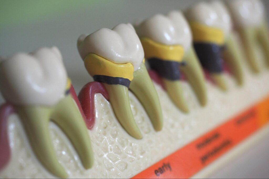 歯 模型